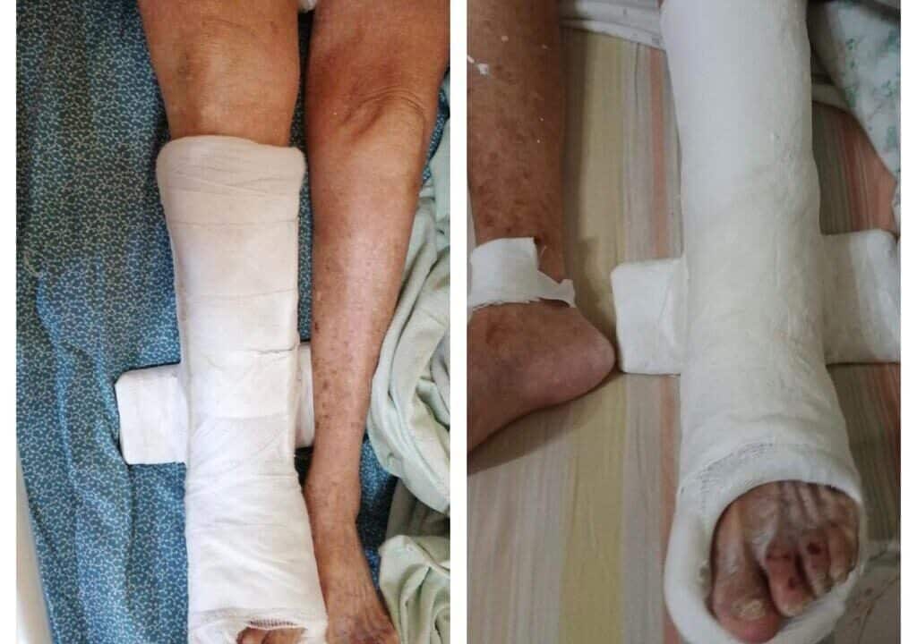 A una centenaria con il femore rotto è stata fatta una ingessatura sbagliata per ben due volte