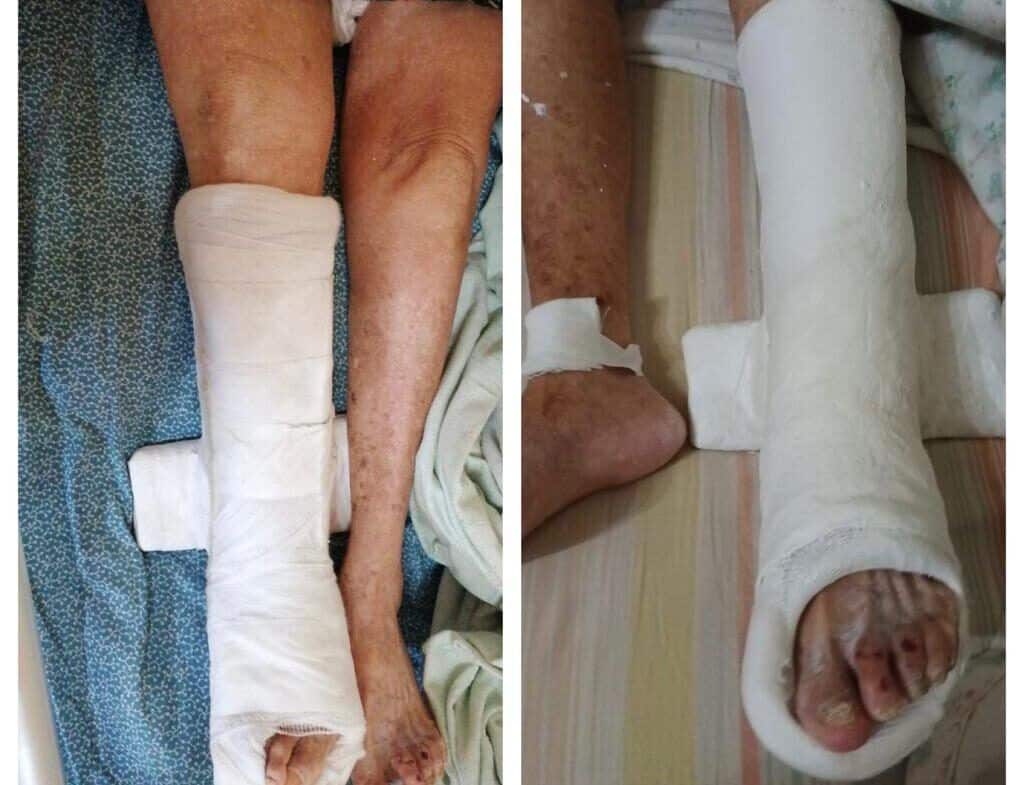 A una centenaria con il femore rotto è stata fatta una ingessatura sbagliata per ben due volte