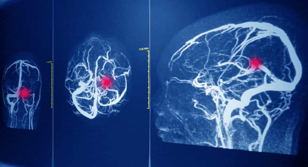 Medico scambia un'aneurisma per la cervicale