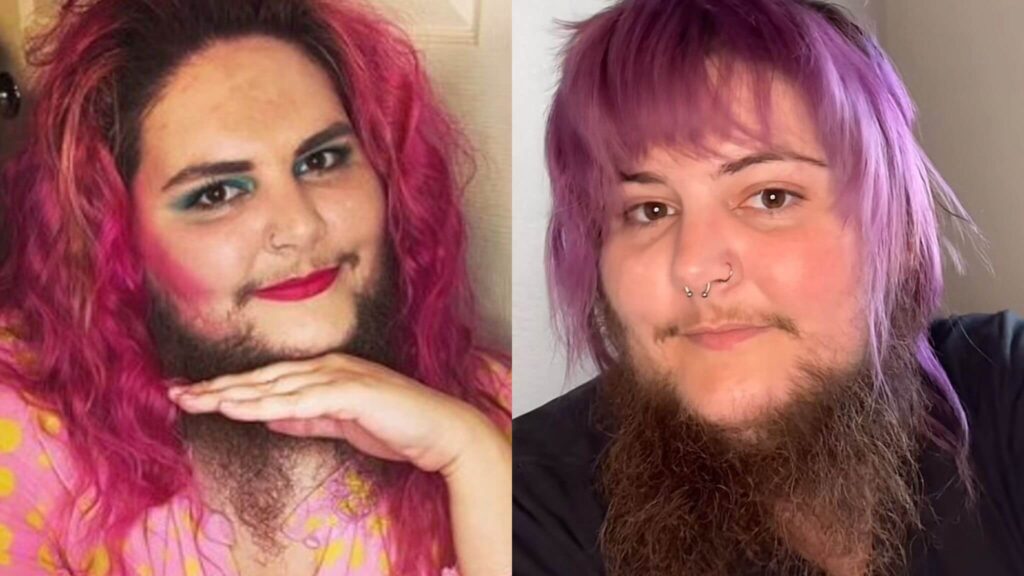 Dakota Cooke, la giovane con la barba: "Mi sento più sexy che mai"