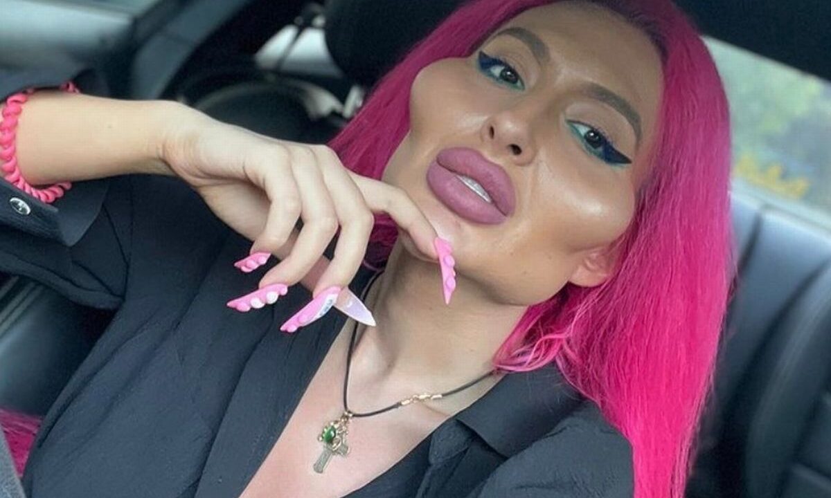 La modella 33enne ha ammesso che le sue guance stanno iniziando a sgonfiarsi e avrebbero bisogno di un altro ritocchino