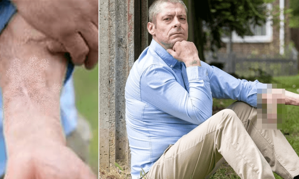 Grave infezione e perde il pene, poi ricostruito sul braccio Ecco come è cambiata la mia vita