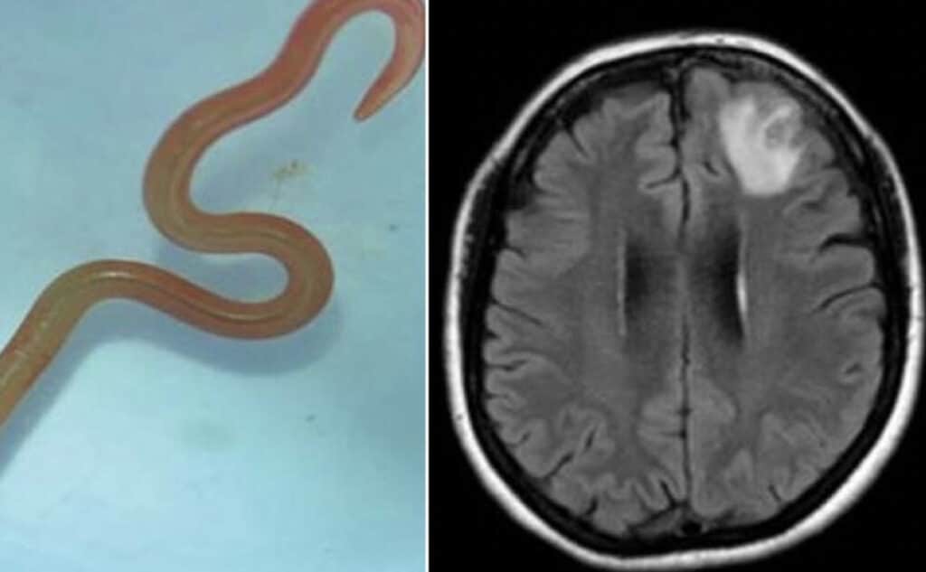 a un verme di 8 centimetri, vivo, nel cervello”: scoperta shock in Australia.