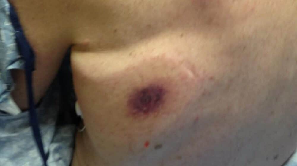 batterio killer mangiacarne