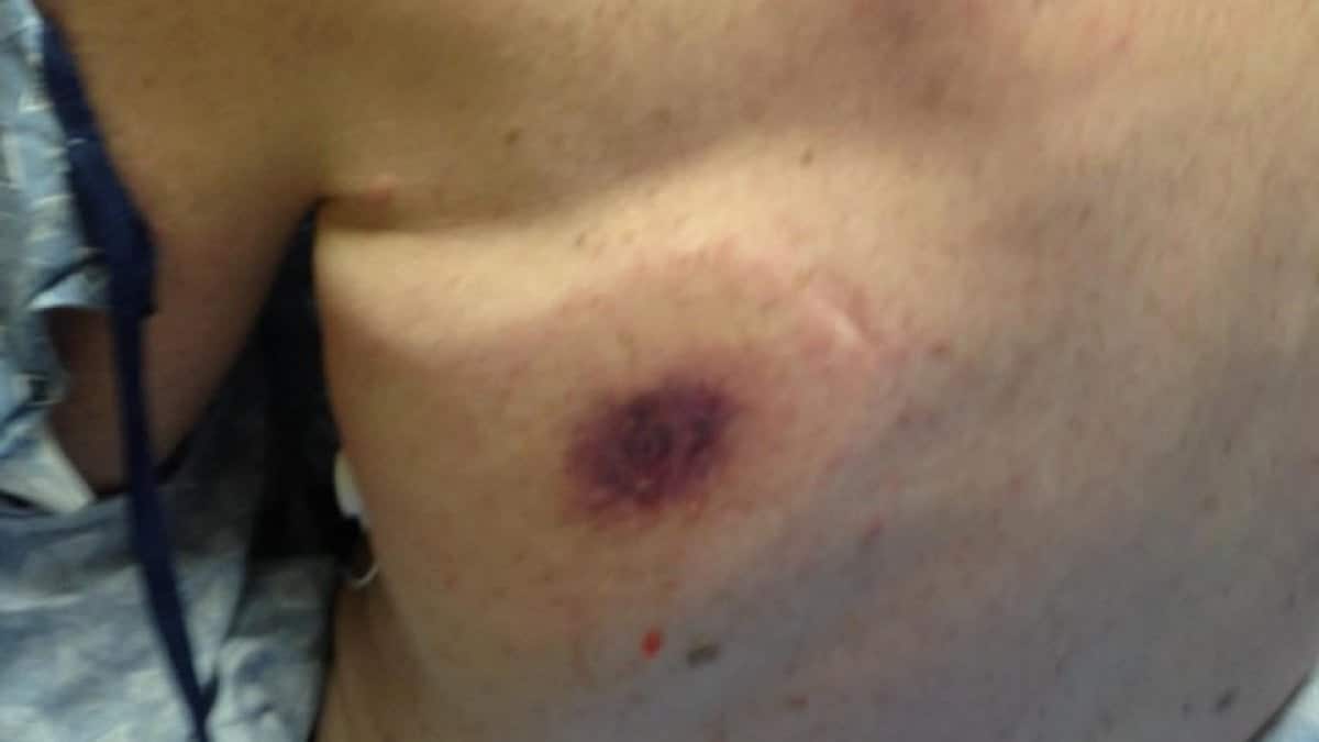 batterio killer mangiacarne