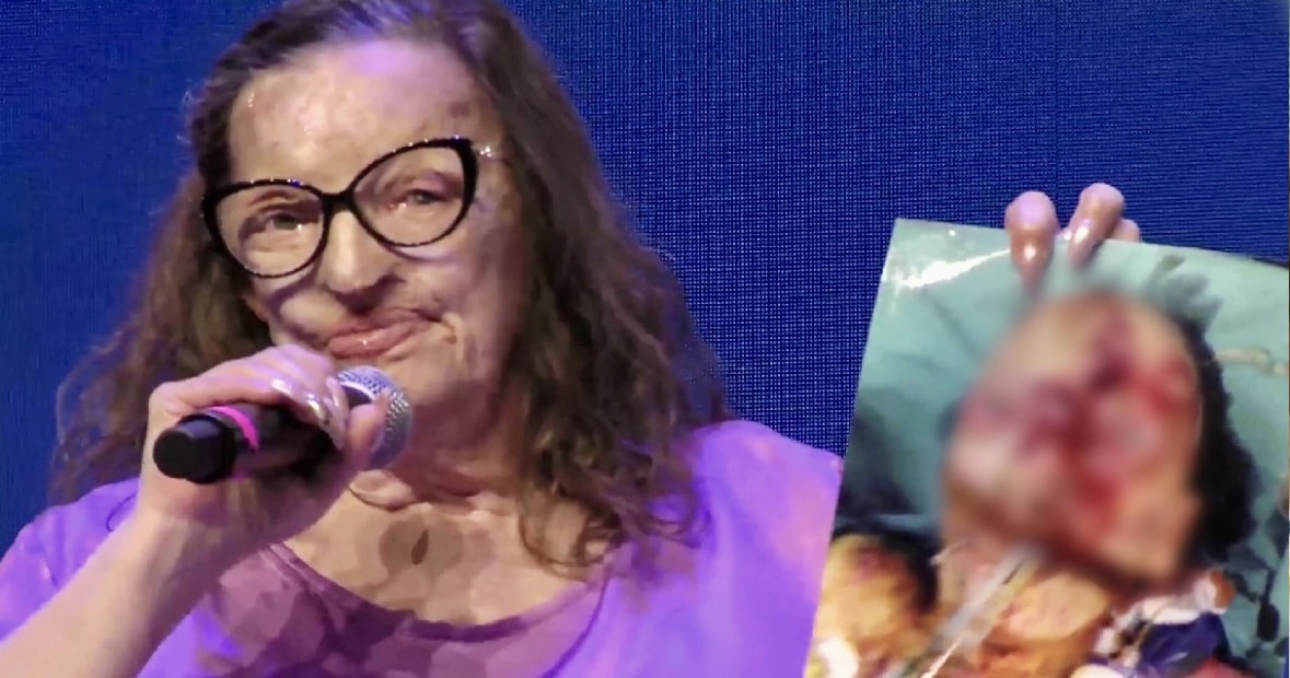 Filomena Lamberti, la prima donna sfregiata con l’acido al Berlusconi Day