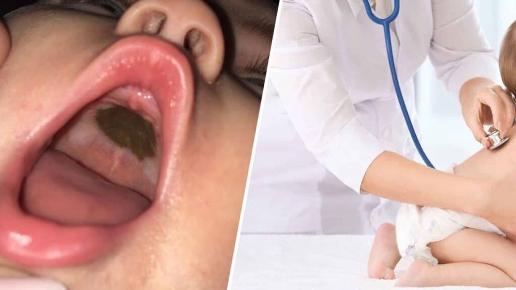 macchia nera sul palato