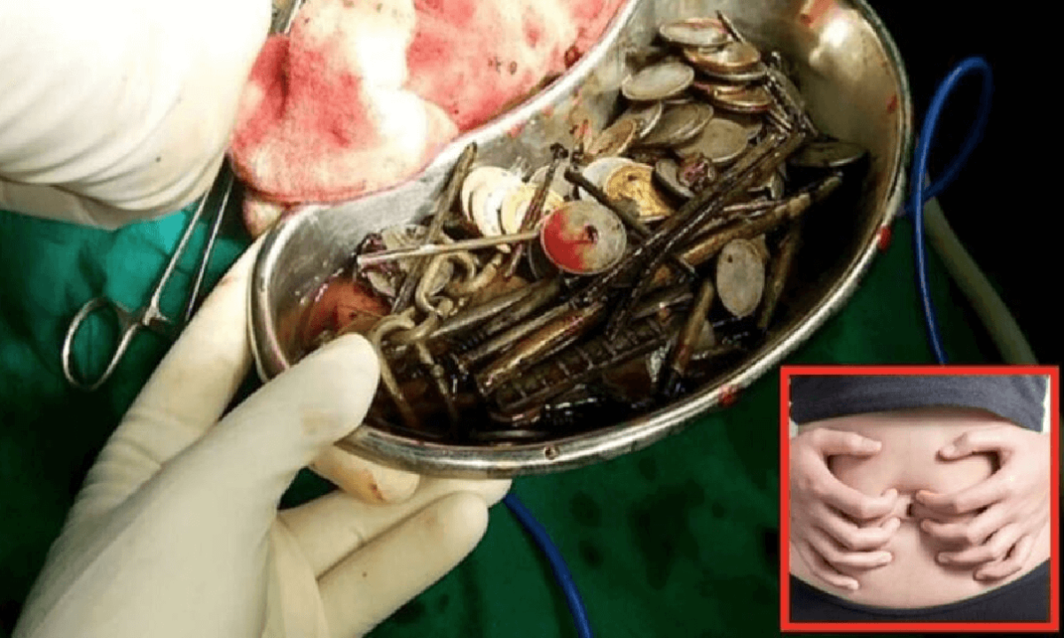 Va al pronto soccorso, gli trovano bulloni e chiodi nello stomaco, il caso a Latina