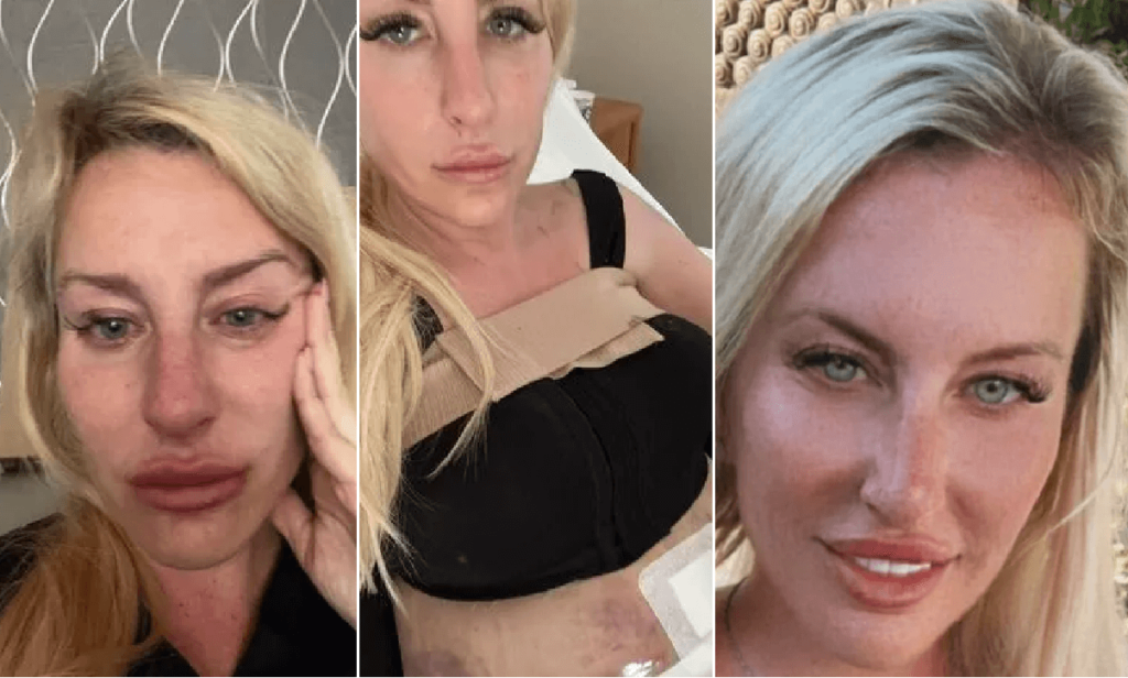 Va in Turchia per rifare il seno e la liposuzione Ho rischiato la vita, la confessione
