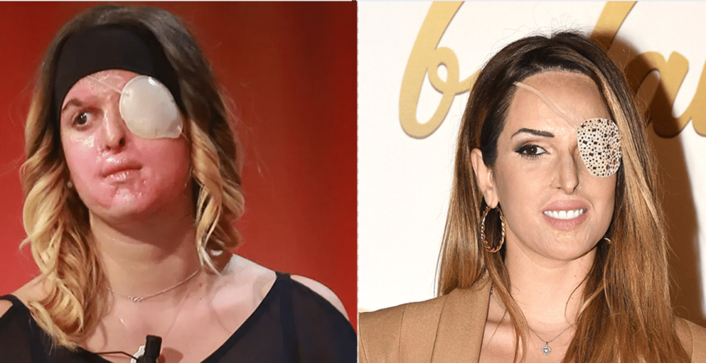 Gessica Notaro tornerà a vedere dall'occhio sinistro