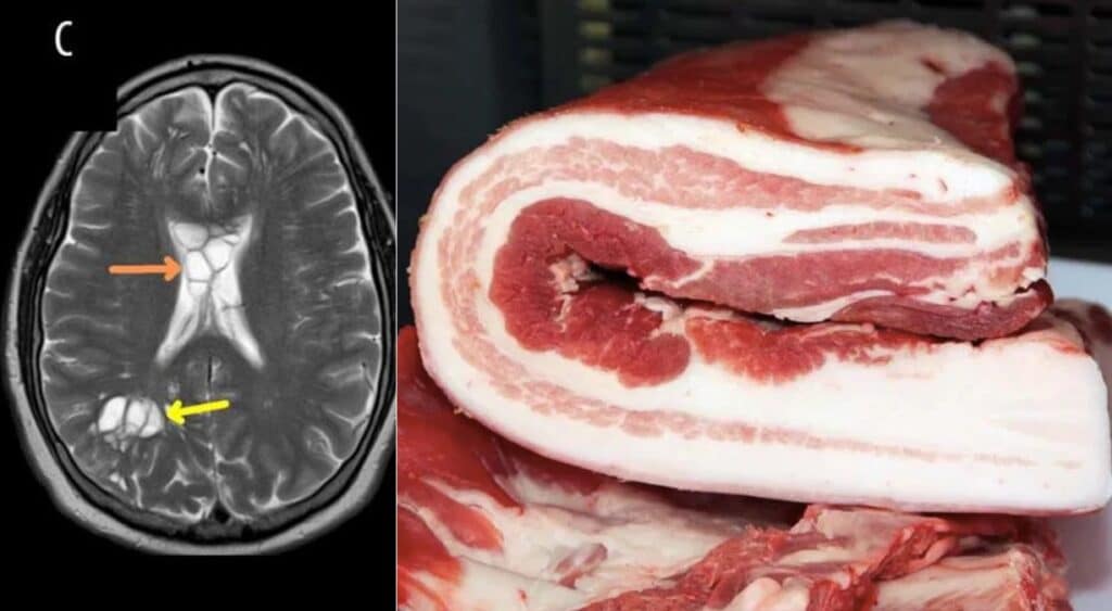 Ha il verme solitario nel cervello: colpa della pancetta cruda