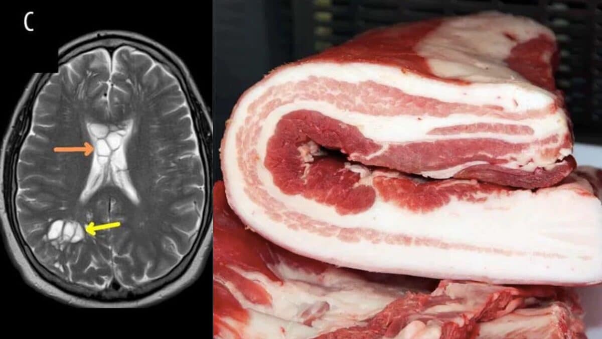 Ha il verme solitario nel cervello: colpa della pancetta cruda