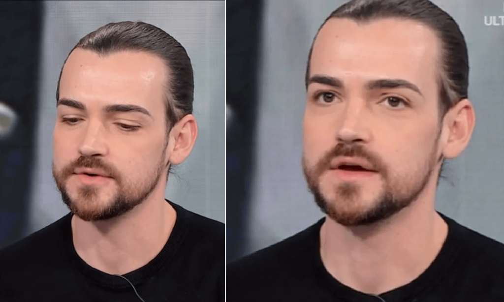 Il tumore di Valerio Scanu Mi hanno asportato metà polmone dopo l'operazione