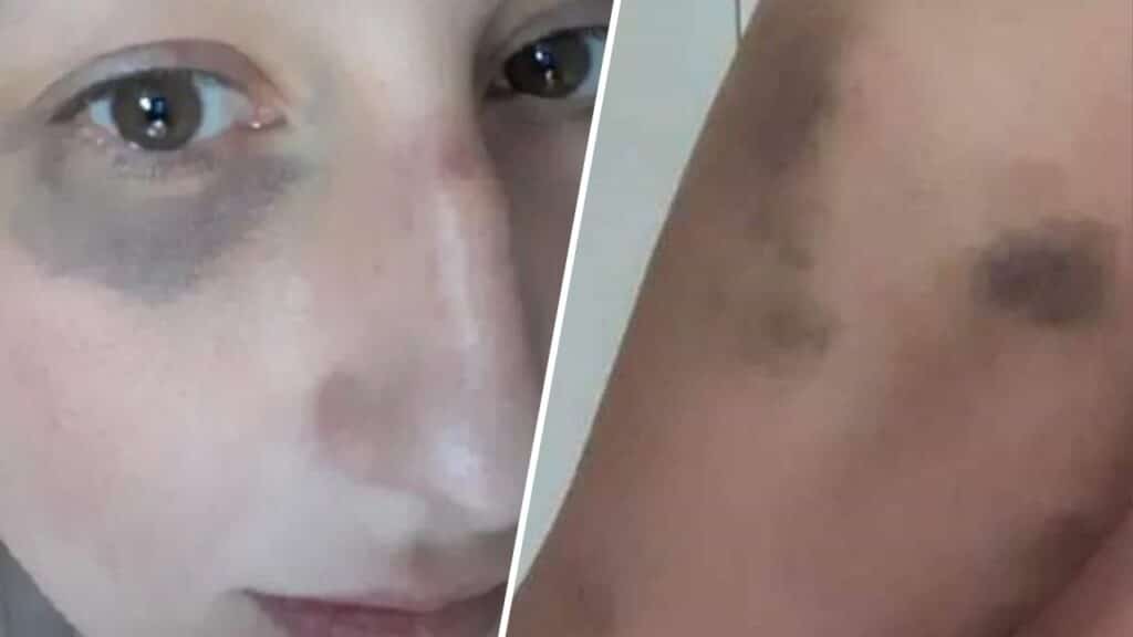 denunciò ex tentato omicidio