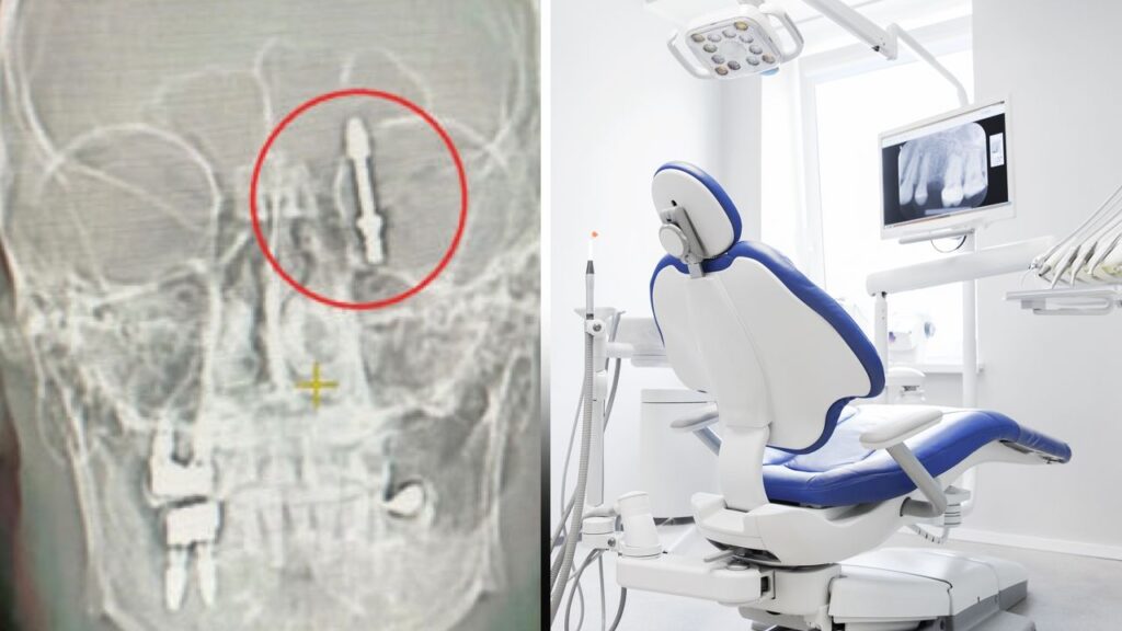 "Solo quando ho urlato per il dolore ha capito la gravità." Ha raccontato il paziente che ha avviato una battaglia legale contro il dentista che si rifiuta di risarcirlo