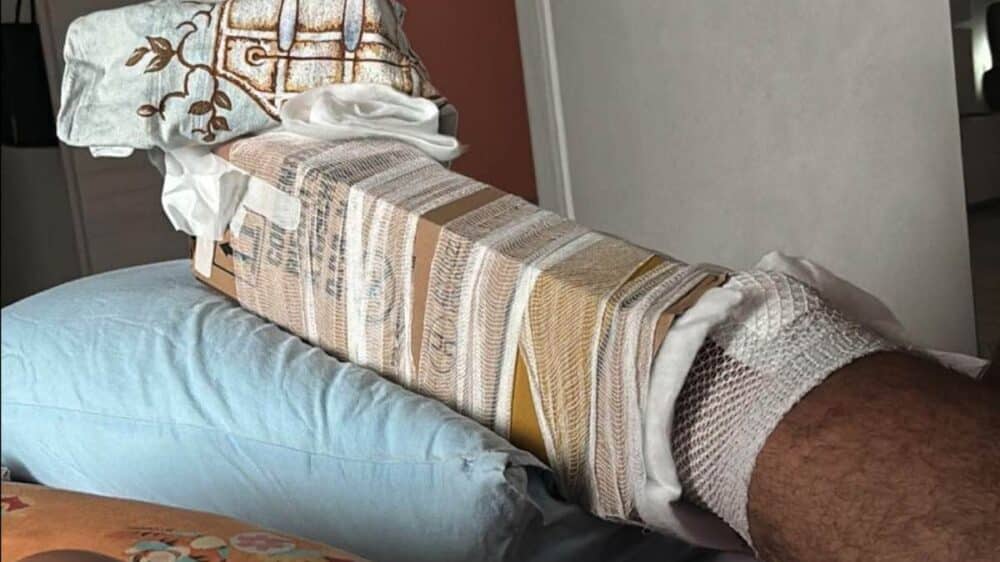 Patti, finiscono le stecche e bloccano la frattura con un cartone