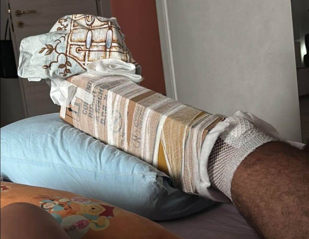 Patti, finiscono le stecche e bloccano la frattura con un cartone