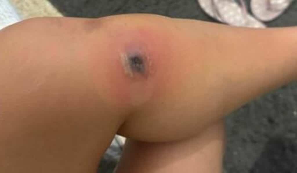 morso ragno violino gamba necrosi